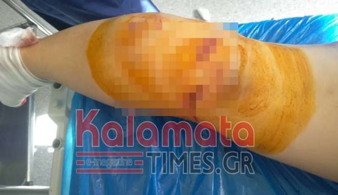 Καλαμάτα: Αγέλη σκύλων κατασπάραξε 34χρονη μητέρα -«Νόμιζα ότι θα με σκοτώσουν»